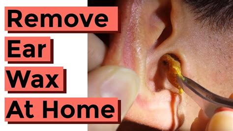 how to remove impacted cerumen